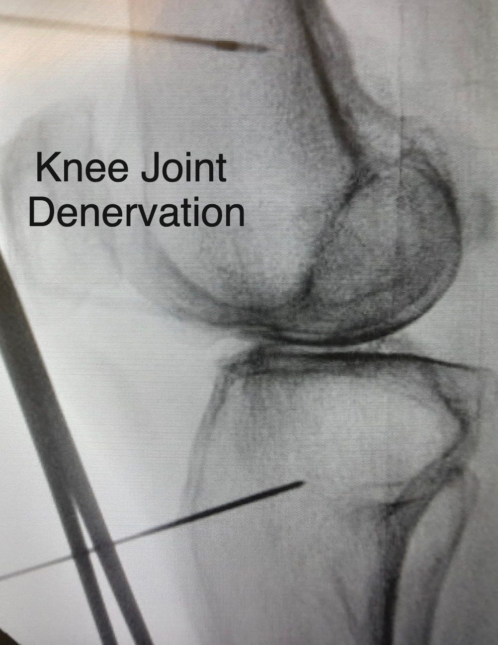 Joint Denervation