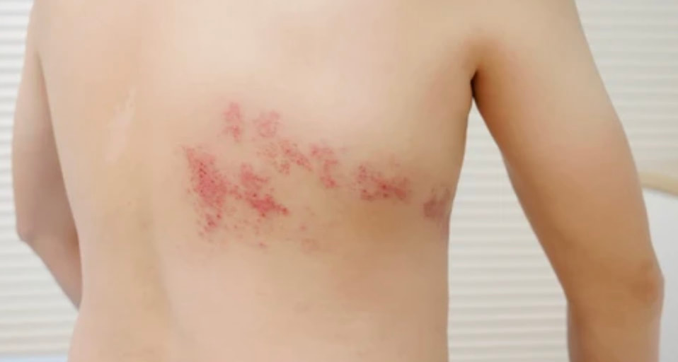 DIAGNOSIS OF SHINGLES