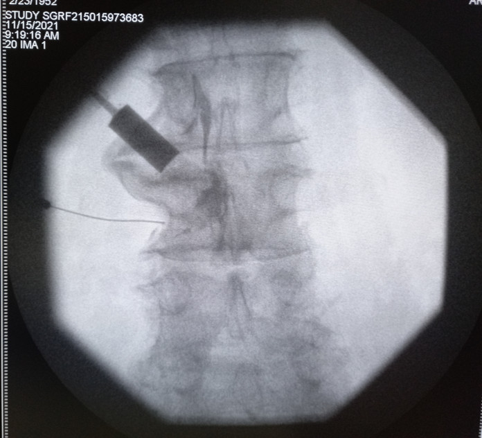Doctor reviewing spinal X-ray to diagnose disc herniation and back pain conditions
