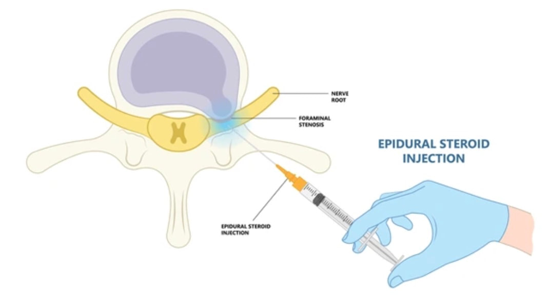 Epidural Steroid Injection