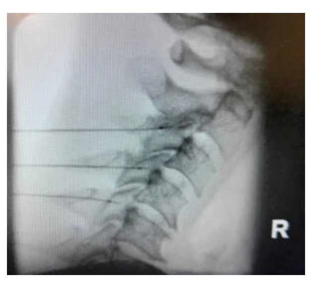 Facet Joint Injections and Radiofrequency Ablation