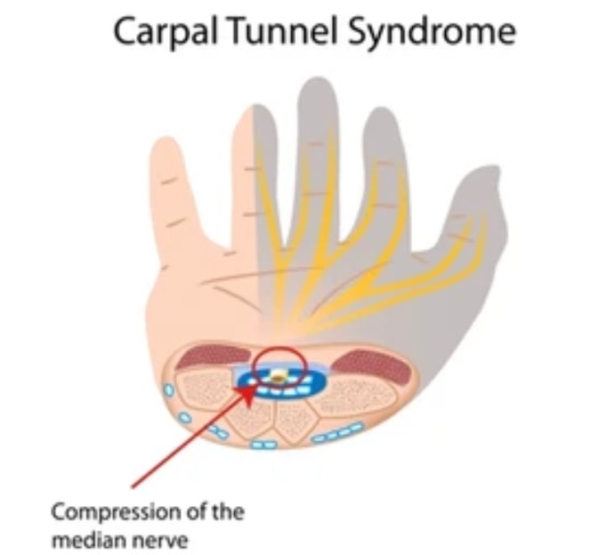 carpal-tunnel_orig