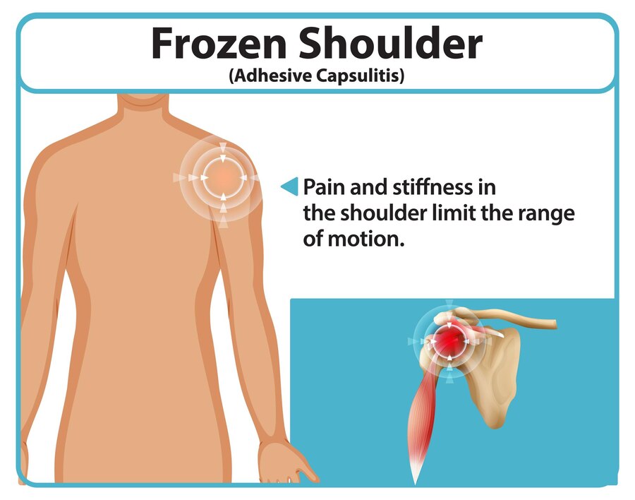 frozen shoulder