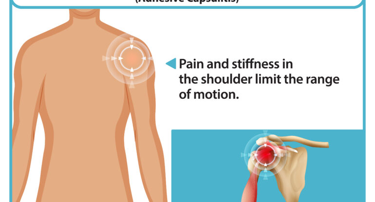 understanding what frozen shoulder is