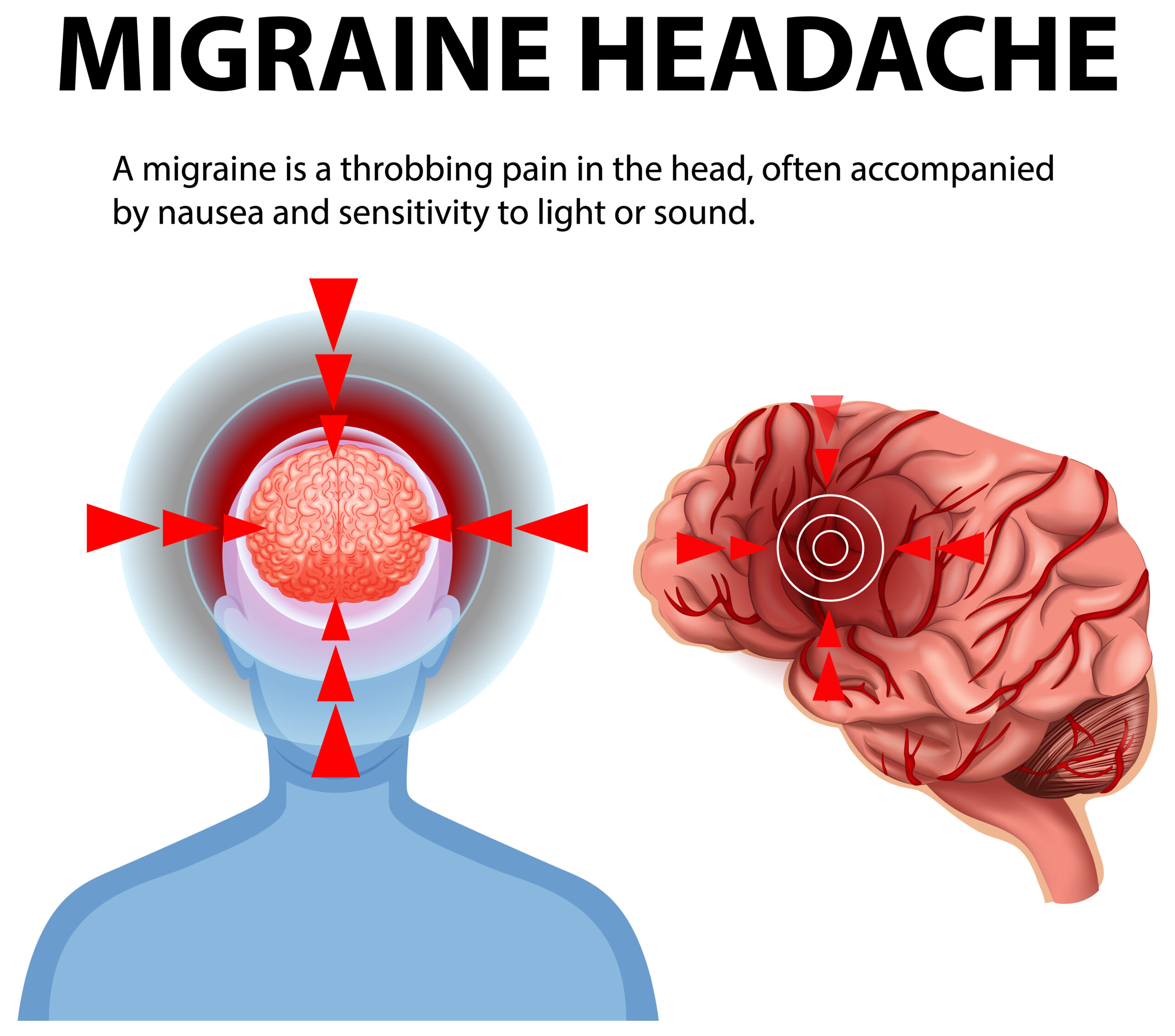 Understanding Migraine Headache Symptoms