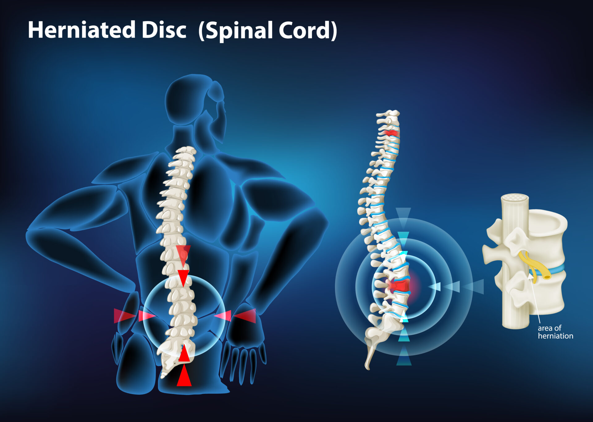 Symptoms of Slipped Disc and Bulging Disc in the Back