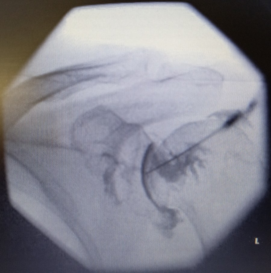 Fluoroscopic (X-ray) image of the shoulder joint taken during a hydrodilatation procedure, with a needle in the joint