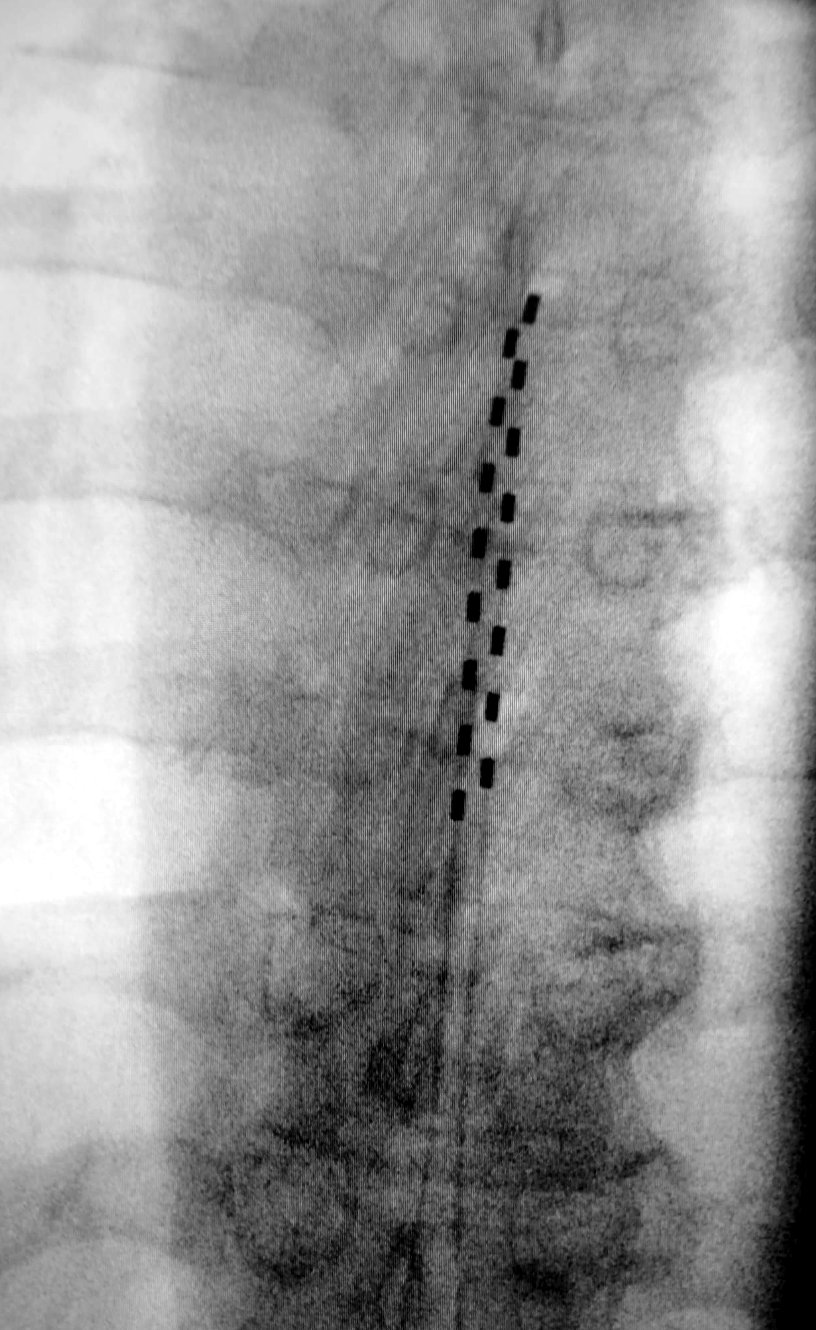 X-ray (fluoroscopy) image showing a spinal cord stimulation lead in the epidural space of the spine