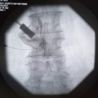 An Epidural steroid injection is performed under X-ray guidance. Steroids are deposited around the nerve roots to reduce inflammation and pain from disc herniation