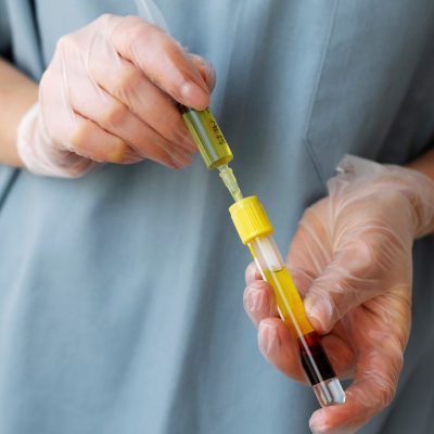 PRP treatment PRP treatment